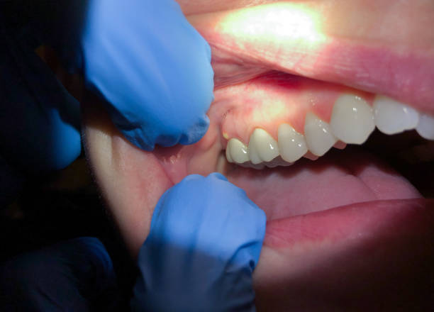 Best Emergency Dentist for Knocked-Out Tooth in Brookville, NY